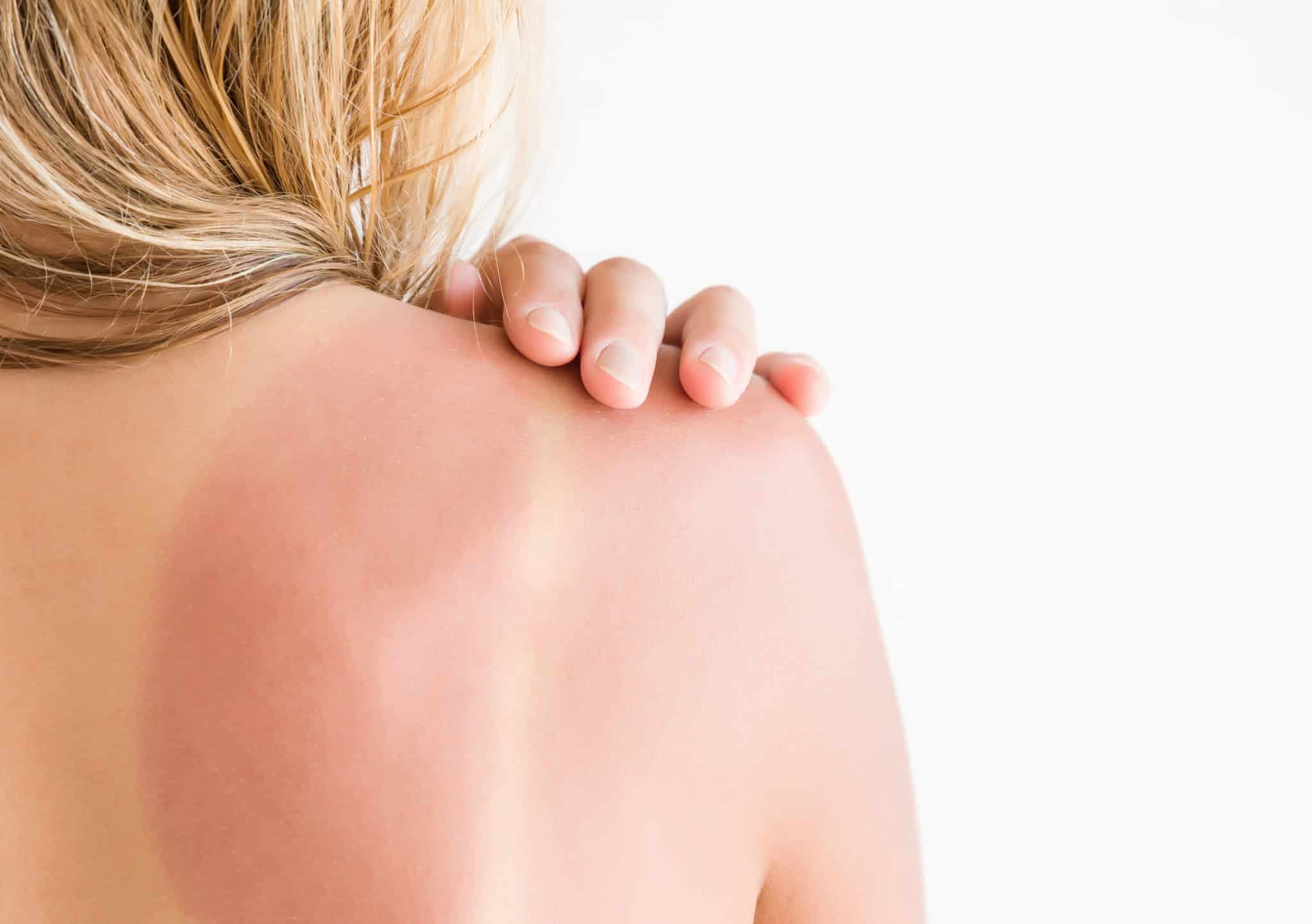 sun effect on skin